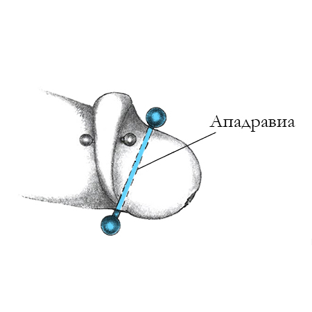 Интимный мужской пирсинг Ападравиа (Ападравия)